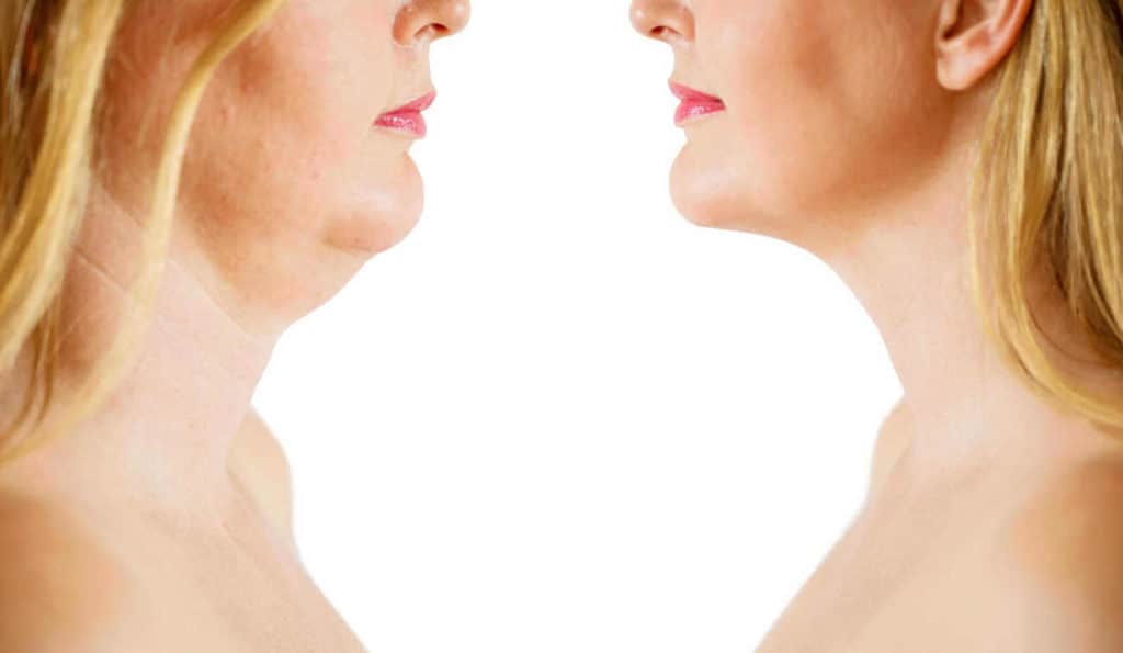 Double Chin treatment Merton before and after results