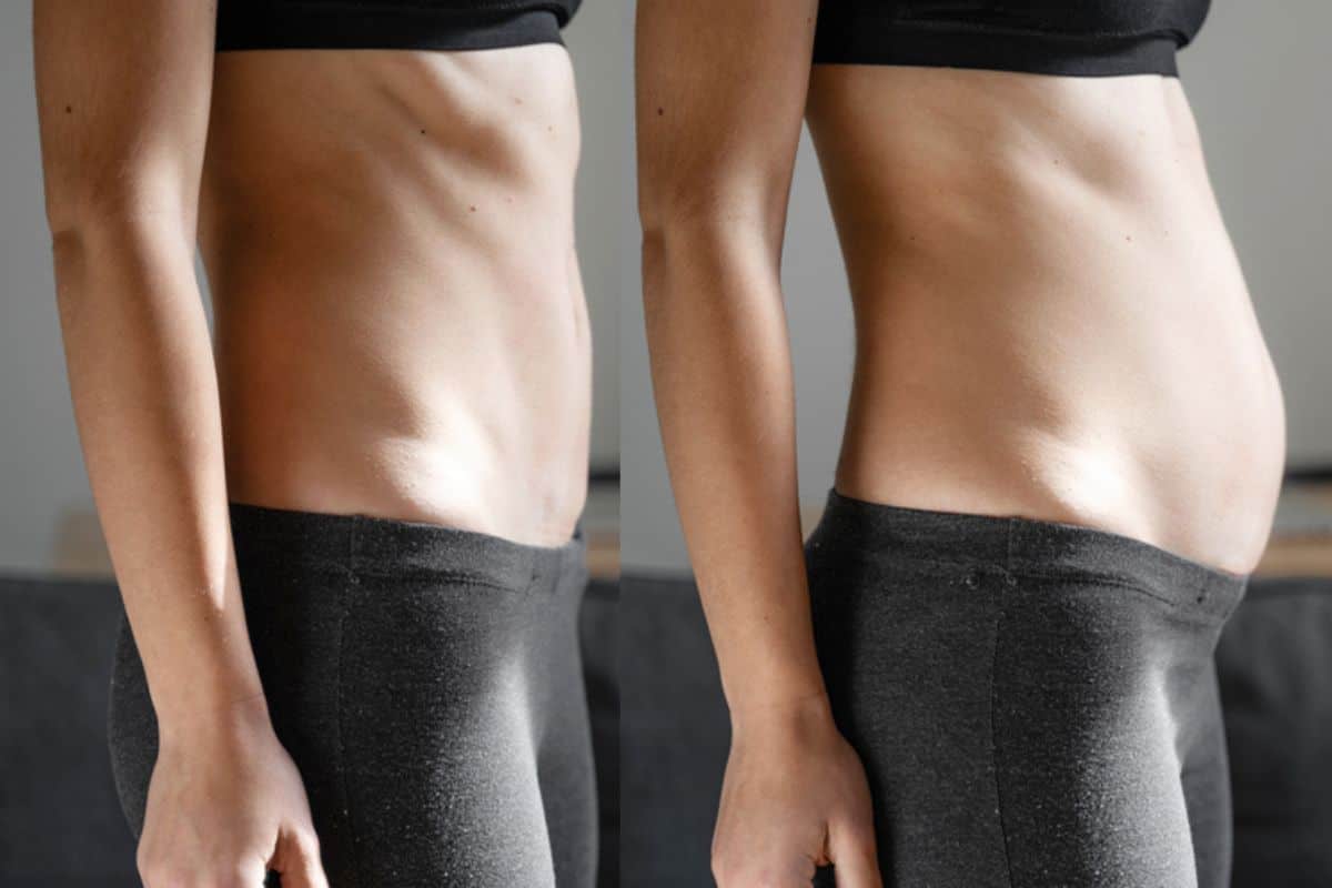 How long does diastasis recti take to improve Merton?
