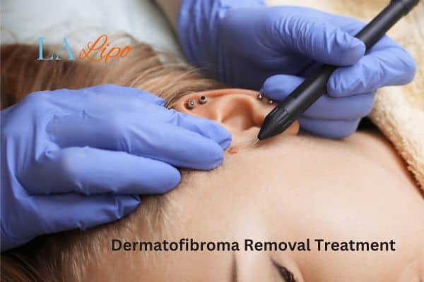 Dermatofibroma Removal Treatment Merton