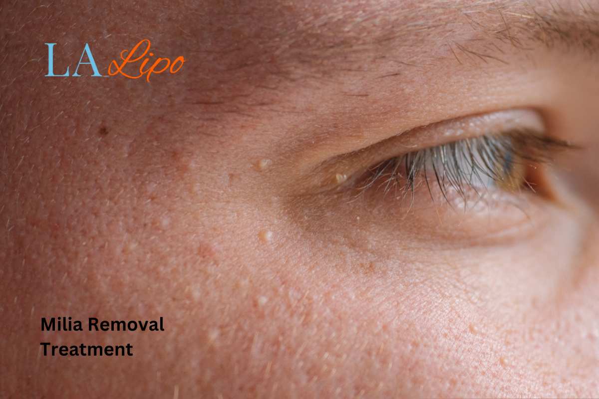 Cryopen Milia Removal: Is It the Easiest and Safest Option Merton?