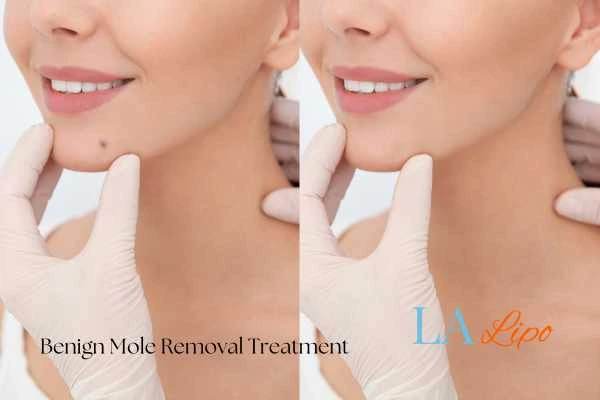 woman's before and after mole removal Merton results