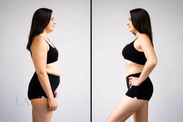 image of woman before and after results of LA-EMS Body Sculpting Merton to help treat Diastasis recti