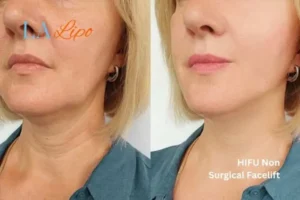 hi-fu for wrinkles Merton before and after results