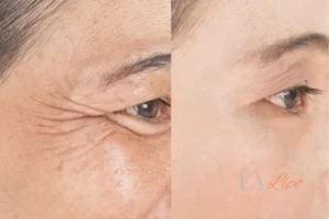 Before and after results of woman - HI-fu wrinkles reduction treatment Merton
