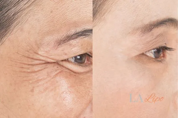 Before and after results of woman - HI-fu wrinkles reduction treatment Merton