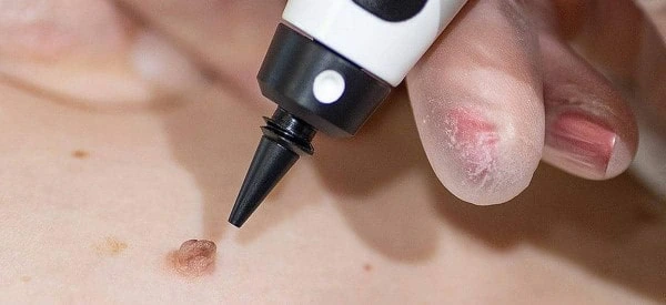 skin tag removal using cryopen Merton