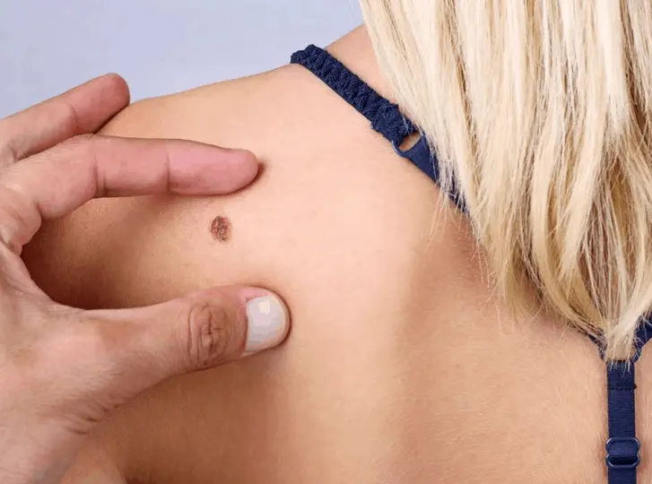 woman having mole removal Merton consultation before treatment.