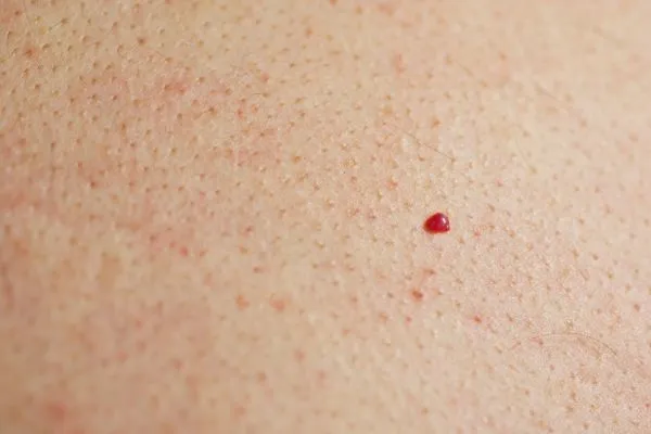 close up of a cherry angioma Merton