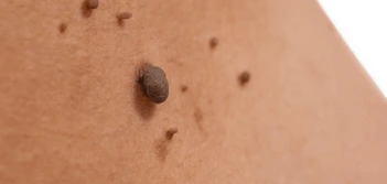 image of a skin tag Merton