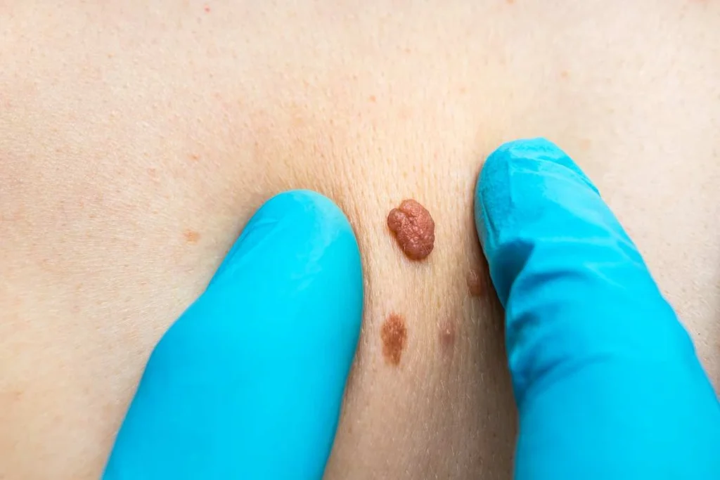 Consultant examining a skin tag Merton