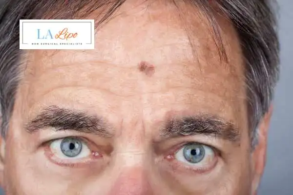 Solar Lentigo Removal Merton image of man with mark on his forehead