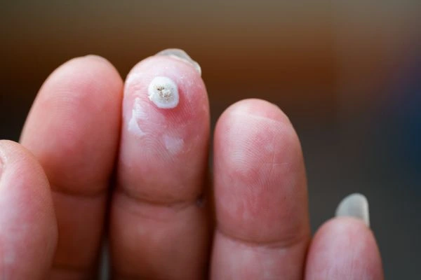 wart on person finger - cryotherapy to treat from LA LIPO Merton