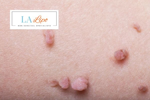 Does cryopen skin tag removal Merton hurt? Find out now call our team today!