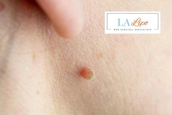 Book skin tag removal Merton today speak to our team now!