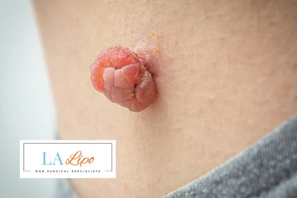 Interested in skin tag removal Merton? Concerned about the pain? Find out more today!