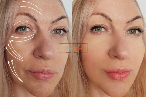 Morpheus 8 results Merton face lift.