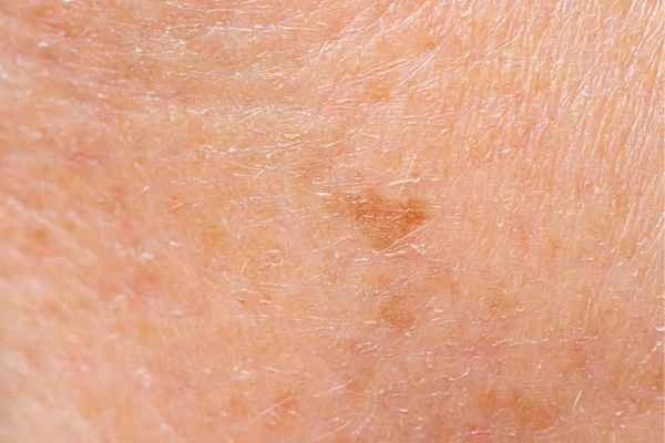 close up picture of age spots Merton