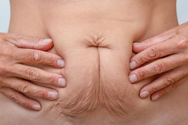 Should I Combine Diastasis Recti Treatment with Body Contouring for Better Results Merton?
