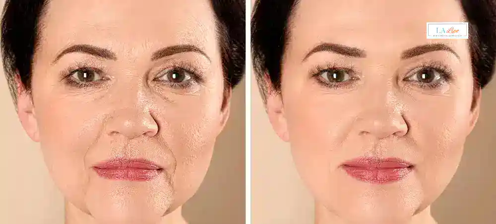 How Long Does It Take to See Results and How Long Do They Last Merton?